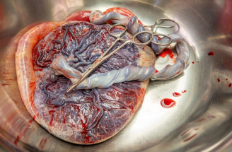 Placenta a jej komplikácie. Kedy je nutný chirurgický zákrok?